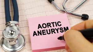 Aortic aneurysm symptoms, causes and prevention measures – Know what are the causes, symptoms and treatment of aortic aneurysm